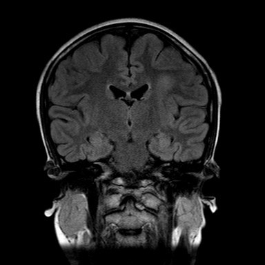 MRI Brain FLAIR
